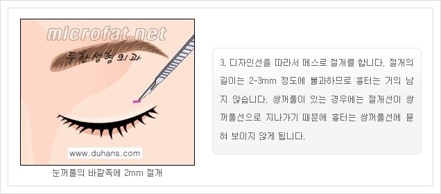 [두한성형외과 경쟁력 지방제거] - [눈 지방제거 안내] 관련 이미지 5