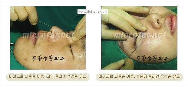 [두한성형외과 경쟁력 눈밑성형] - [눈밑 다크써클과 눈밑 함몰주름의 최적화 교정방법 안내] 관련 이미지 4