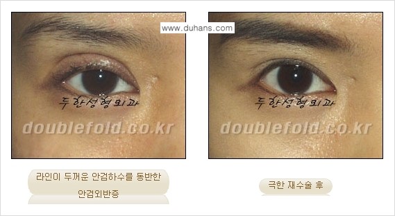 [두한성형외과 NO.1 경쟁력 눈성형] - [일반 쌍꺼풀 재수술과 극한 눈(쌍꺼풀) 재수술과의 차이점] 관련 이미지 7
