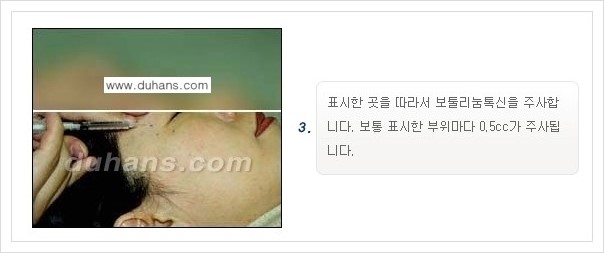 [두한성형외과 경쟁력 주름성형] - [얼굴 주름제거 보톡스 안내] 관련 이미지 3