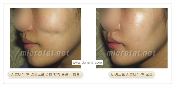 ​[두한성형외과 경쟁력 미세지방이식] - [타 병원에서 지방이식 후 발생한 굴곡현상 교정 방법 - 마이크로 지방이식] 관련 이미지 7