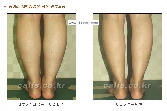 [두한성형외과 날씬한 종아리 만들기!] - [종아리 성형 안내 2.] 관련 이미지 7