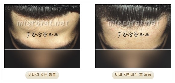 [두한성형외과 경쟁력 지방이식 리더] - [Col-fat(콜펫)지방이식, 3차원 입체지방이식, 2차원 평면지방이식] 관련 이미지 70