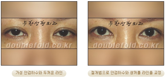 [Duhan Plastic Surgery Secondary Double Eyelid Surgery] - [Sleepy Eye Appearance, Asymmetrical Eye Appearance, Ptosis] image 19