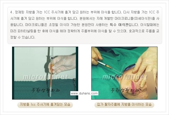 [두한성형외과 경쟁력 지방이식] - [입가주름, 팔자주름 미세지방이식의 안내] 관련 이미지 7