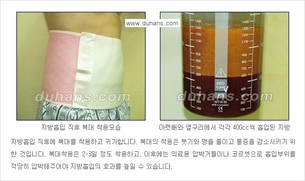 [두한성형외과 성형 FOCUS 간편 지방흡입] - [비만 탈출! 초음파 지방흡입 ②] 관련 이미지 6