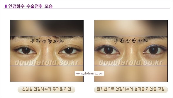 [두한성형외과 경쟁력 쌍꺼풀 재수술, 극한 눈재수술] - [안검하수 검사 및 수술방법 안내] 관련 이미지 10