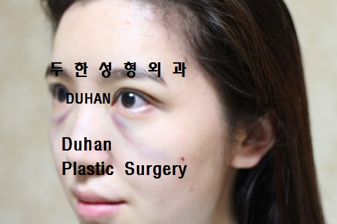 #눈밑수술 과 #쌍꺼풀 수술 , #눈밑지방이식 #인디언밴드 #앞광대주름 #눈물고랑 관련 이미지 5