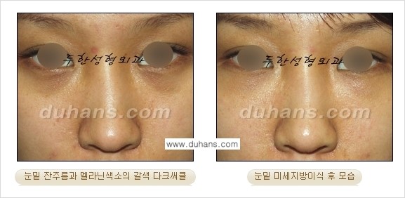 [두한성형외과 경쟁력 미세지방이식] - [다크써클 & 눈밑주름 미세지방이식 3.] 관련 이미지 12