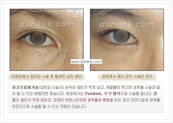 [두한성형외과 경쟁력 눈성형] - [앞트임 수술(몽고주름 제거) 안내 ①] 관련 이미지 7