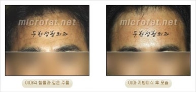 [두한성형외과 얼굴자가지방이식] - [지방이식 과정] 관련 이미지 20