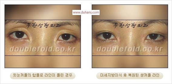 [두한성형외과 경쟁력 쌍꺼풀 재수술 리더] - [풀린 쌍꺼풀, 풀려버린 쌍꺼풀 재수술 방법 안내] 관련 이미지 8