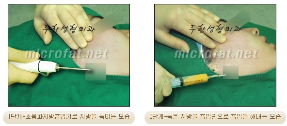 [Duhan Plastic Surgery Liposuction] - [Facial Liposuction] image 8