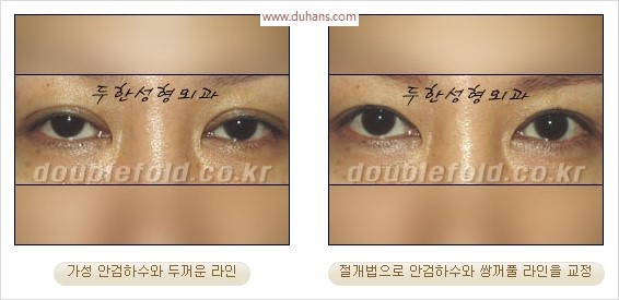 [두한성형외과 경쟁력 눈성형] - [극한 재수술, 함몰된 눈꺼풀 라인교정, 안검하수(졸리운 눈매)] 관련 이미지 99