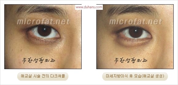 ​﻿[두한성형외과 경쟁력 지방이식] - [눈밑 애교살 시술을 위한 미세지방이식] 관련 이미지 18