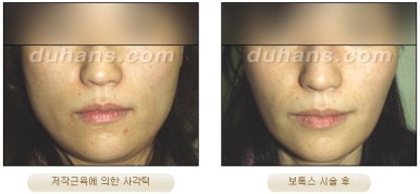 [Duhan Plastic Surgery Clinic Aesthetic Procedures] - [Square Jaw Botox] image 6
