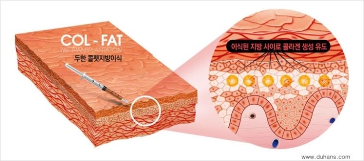 ​[두한성형외과 다크써클 치료] - [눈밑이 전반적으로 함몰된 다크써클 증상] 관련 이미지 4