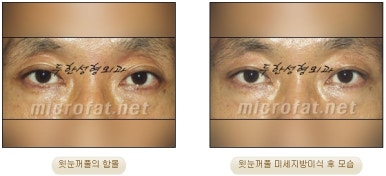 [Doohan Plastic Surgery Autologous Fat Grafting] - [Sunken Eye Fat Grafting] image 19