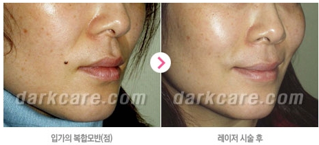 [두한성형외과 콤비프로그램] - [다크서클 + 검버섯 레이저] 관련 이미지 9