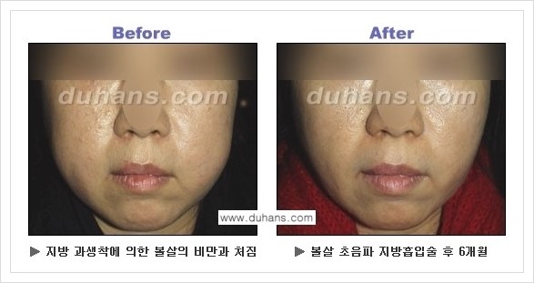 [두한성형외과 경쟁력 지방흡입] - [볼살지방흡입 안내] 관련 이미지 5