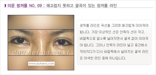 [두한성형외과 경쟁력 눈성형] - [나에게 맞는 맞춤 쌍꺼풀 찾기] 관련 이미지 9