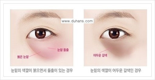 [두한성형외과 경쟁력 다크써클 교정] - [다크써클 5단계로 이뤄지는 핵심 5 STEP SOLUTION 안내 1.] 관련 이미지 4