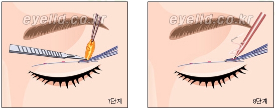 [Double Eyelid Surgery Duhan Plastic Surgery] - [Buried Method, Incision Method, Partial Incision Method] image 24