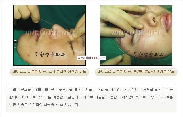 [두한성형외과 경쟁력 눈밑성형] - [꺼진 눈밑, 눈밑 함몰 주름선 눈밑 미세지방이식 안내] 관련 이미지 4