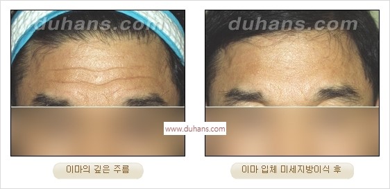 [두한성형외과 경쟁력 주름성형] - [간단하고 부작용 없는 자연스러운 주름제거 방법] 관련 이미지 16