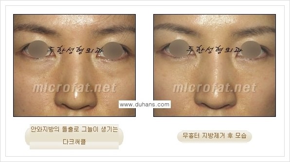 [두한성형외과 경쟁력 눈밑성형] - [눈밑지방제거, 눈위지방제거 안내 2.] 관련 이미지 4
