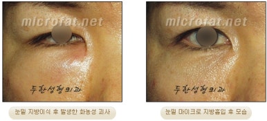 Facial Fat Liposuction at Duhan Plastic Surgery - Cheek Fat Liposuction, Jawline Liposuction, Under-Eye Fat Liposuction image 26