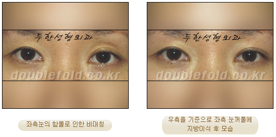 두한성형외과 쌍커풀 재수술 - 짝눈 눈매교정, 가성 안검하수 교정과 뒤밑트임 관련 이미지 14
