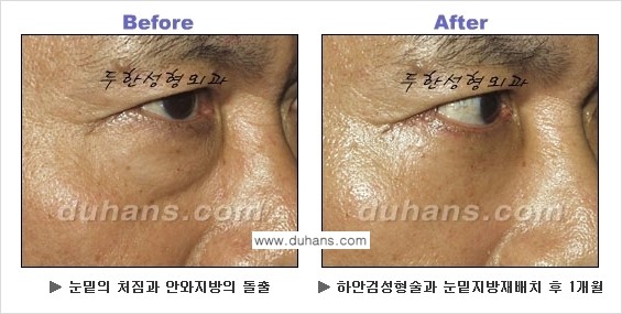[두한성형외과의 상큼하고 환한 젊은 눈매완성] - [하안검 성형술 ②] 관련 이미지 15