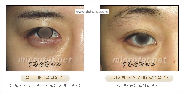 [두한성형외과 경쟁력 눈밑성형] - [눈밑 다크써클과 눈밑 애교살과의 관계 2.] 관련 이미지 4