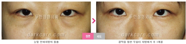 [두한성형외과 다크서클] - [다크서클 전후사진 검증] 관련 이미지 105