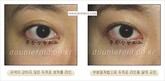 [두한성형외과 경쟁력 눈성형] - [부분절개법(Partial incision method)의 재수술 과정] 관련 이미지 14