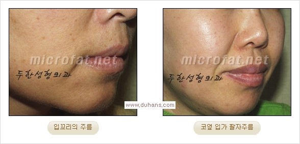 [두한성형외과 경쟁력 주름성형] - [입가주름과 코옆 팔자주름제거 지방이식 시술의 효과] 관련 이미지 2