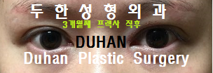 [DuHan Plastic Surgery Double Eyelid Surgery] - [Frequently Asked Questions and Answers About Eye Plastic Surgery] image 18