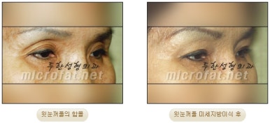 Fat Grafting Leader Duhan Plastic Surgery - Everything About Fat Grafting image 9