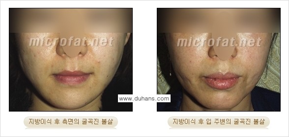 [두한성형외과] - [제대로 된 지방이식으로 부작용에서 탈출하자!] 관련 이미지 1
