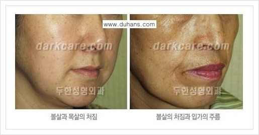 [두한성형외과 경쟁력 주름성형] - [회복과 일상으로의 복귀가 빠른 눈썹거상, 이마주름 엔도타인 리프팅] 관련 이미지 4