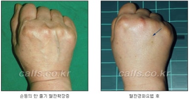 두한성형외과 보기싫은 혈관제거 - 눈밑혈관, 손과 팔의 혈관확장증 치료 관련 이미지 29