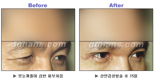 [두한성형외과 안검성형] - [상안검, 하안검] 관련 이미지 12