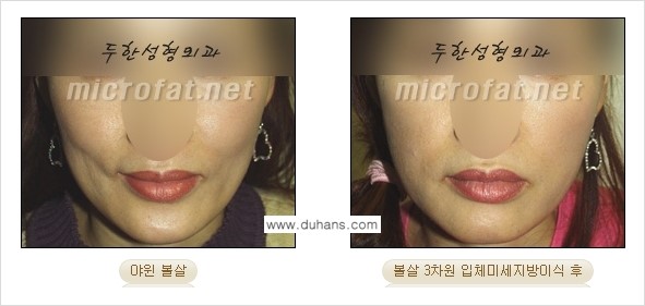 [두한성형외과 경쟁력 미세지방이식] - [두한성형외과 Col-fat(콜펫) 지방이식으로 교정이 가능한 부위 안내] 관련 이미지 8