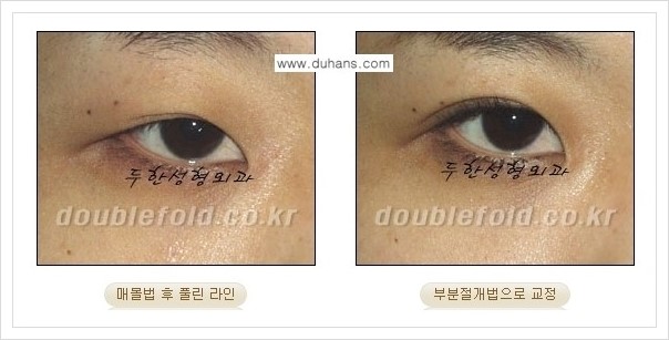 [두한성형외과 경쟁력 쌍꺼풀 재수술(극한 재수술)] - [라인이 풀렸을 경우의 쌍꺼풀 재수술 안내 ②] 관련 이미지 2