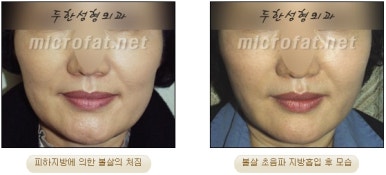 Facial Fat Liposuction at Duhan Plastic Surgery - Cheek Fat Liposuction, Jawline Liposuction, Under-Eye Fat Liposuction image 20