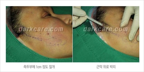 [두한성형외과 경쟁력 주름성형] - [주름제거를 위한 리프팅] 관련 이미지 20