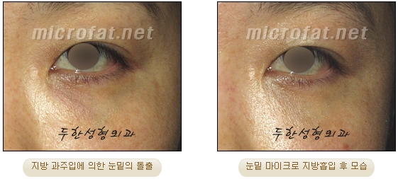 [Duhan Plastic Surgery Liposuction] - [Facial Liposuction] image 14