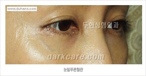 [두한성형외과 경쟁력 눈밑성형] - [눈밑 푸른 혈관 치료방법] 관련 이미지 2