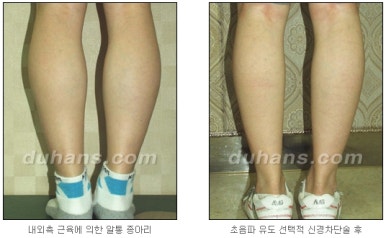 [두한성형외과 종아리 퇴축] - [종아리 퇴축술 재발 재수술] 관련 이미지 20